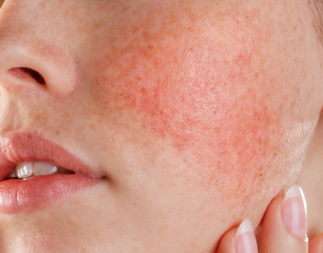 Back To Basics: A Guide To Sensitive Skin - An Interview with Dermatologist, Dr. Mara Evangelista-Huber